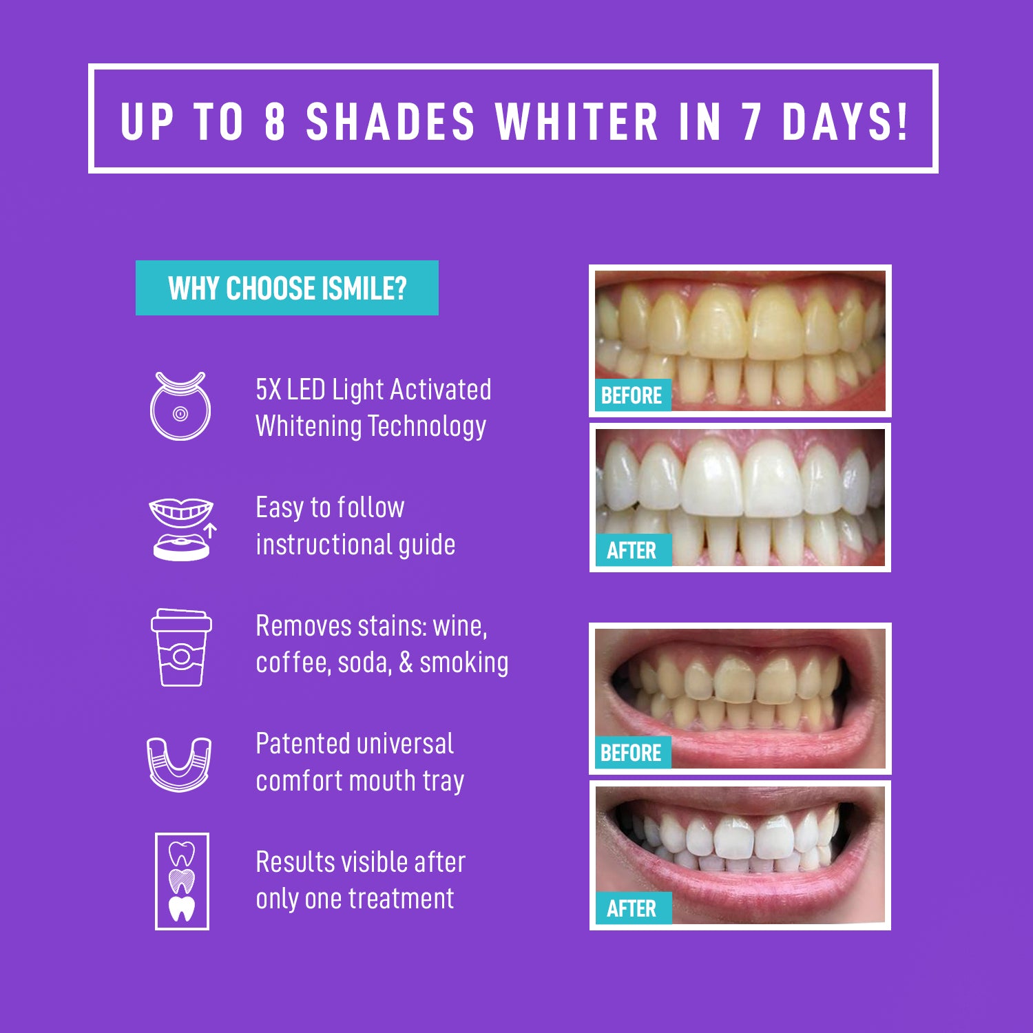 Teeth Whitening London